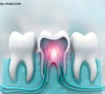 Kill Tooth Pain Nerve in 3 Seconds Permanently